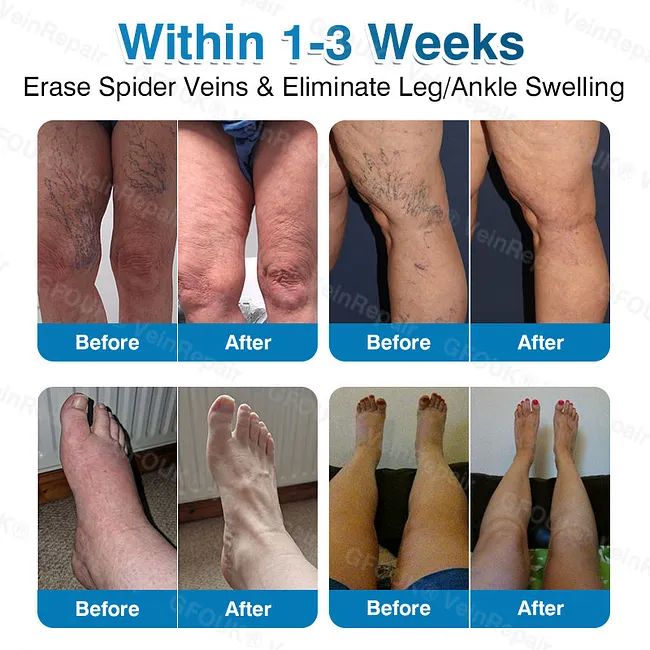 🇦🇺🏆✅️🏃GFOUK® VeinRepair Microneedle Patch Roll⚡Instant Relief, Long-Term Results