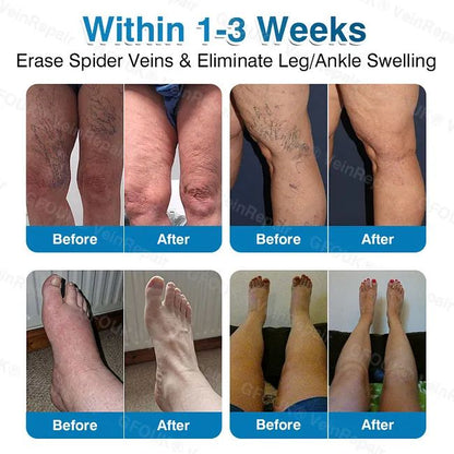 🇦🇺🏆✅️🏃GFOUK® VeinRepair Microneedle Patch Roll⚡Instant Relief, Long-Term Results
