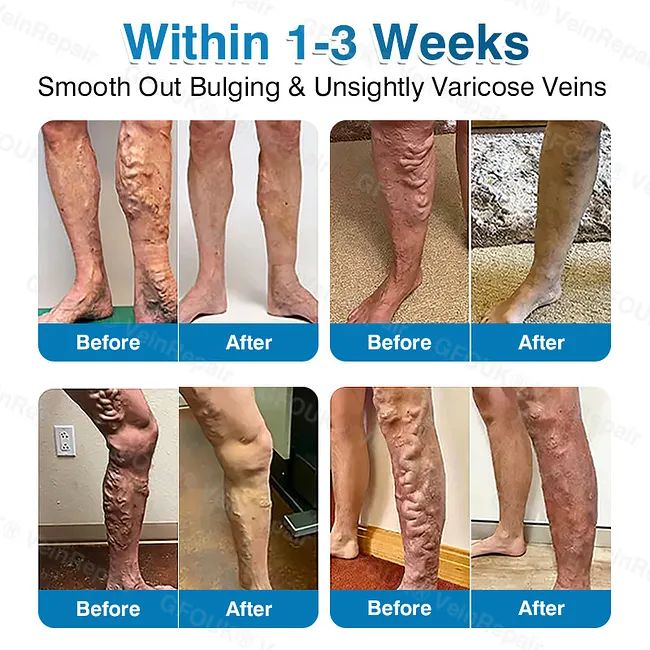 🇦🇺🏆✅️🏃GFOUK® VeinRepair Microneedle Patch Roll⚡Instant Relief, Long-Term Results