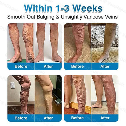 🇦🇺🏆✅️🏃GFOUK® VeinRepair Microneedle Patch Roll⚡Instant Relief, Long-Term Results