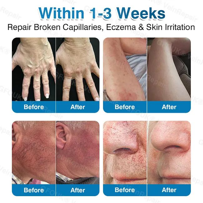 🇦🇺🏆✅️🏃GFOUK® VeinRepair Microneedle Patch Roll⚡Instant Relief, Long-Term Results