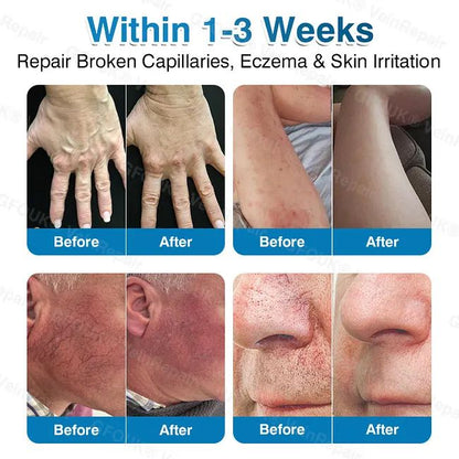 🇦🇺🏆✅️🏃GFOUK® VeinRepair Microneedle Patch Roll⚡Instant Relief, Long-Term Results